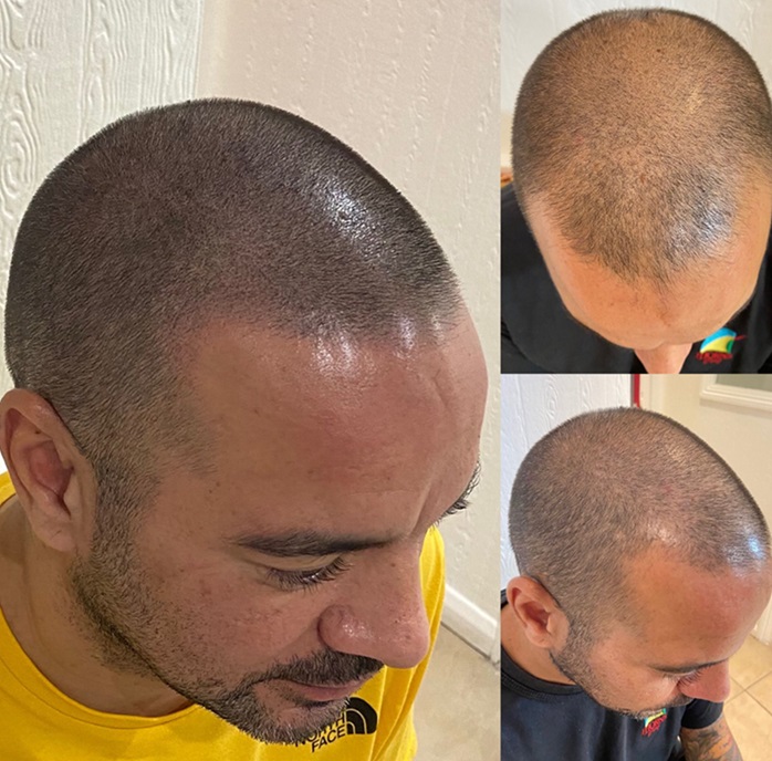 Simon Symeou SMP a Leading Scalp Micropigmentation Clinic in London Launches New Website