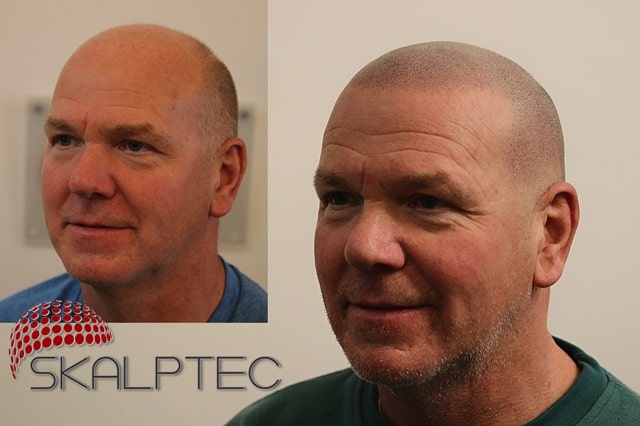 Skalptec celebrates 10 years at the top of the scalp micropigmentation industry